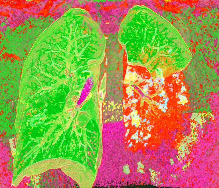 Pneumonia CT scan